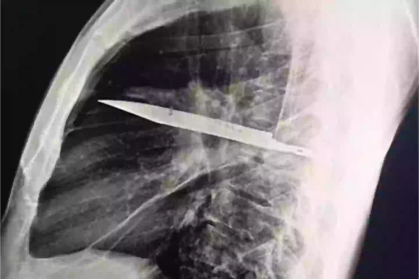 The man was found to have a knife embedded in his chest (National Library of Medicine)