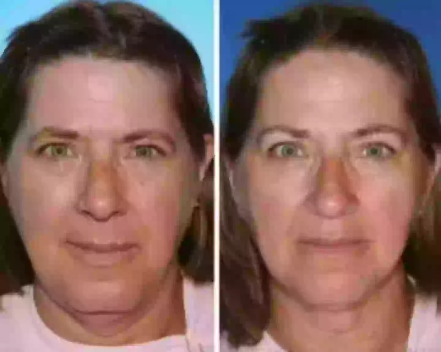 The twin on the left had smoked for more than 20 years longer than her sister (American Society of Plastic Surgeons)