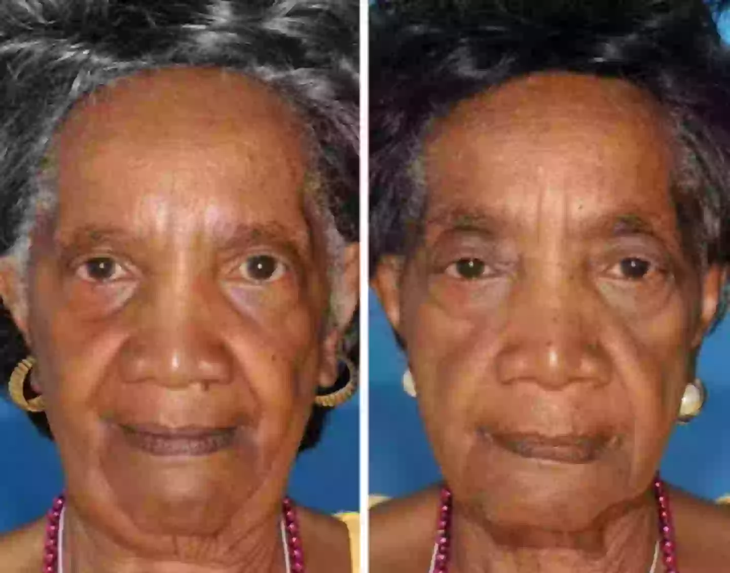 The twin on the left here is a non-smoker. (American Society of Plastic Surgeons)
