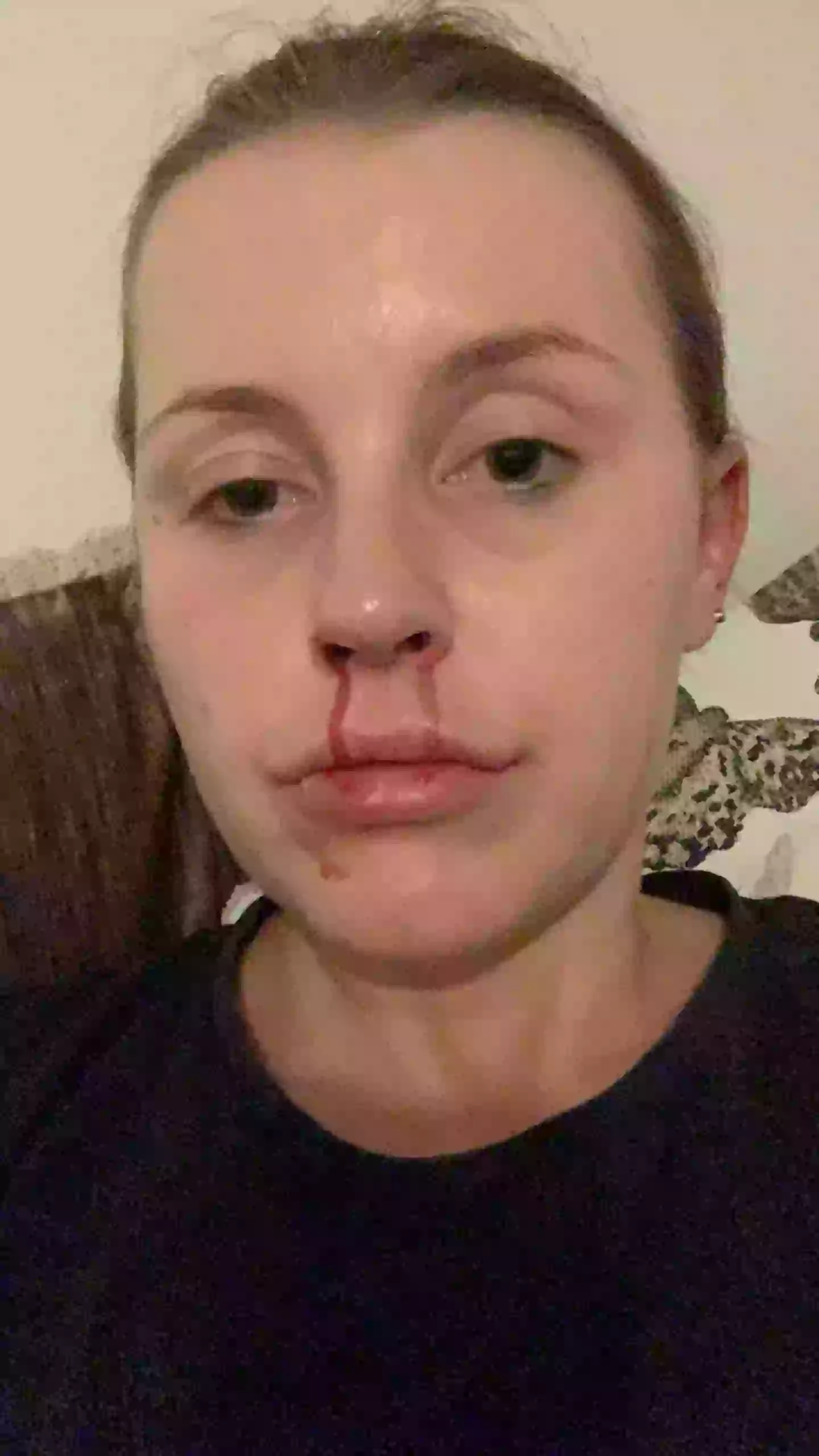 Charlee would suffer with nosebleeds due to her cocaine addiction (Kennedy News and Media)