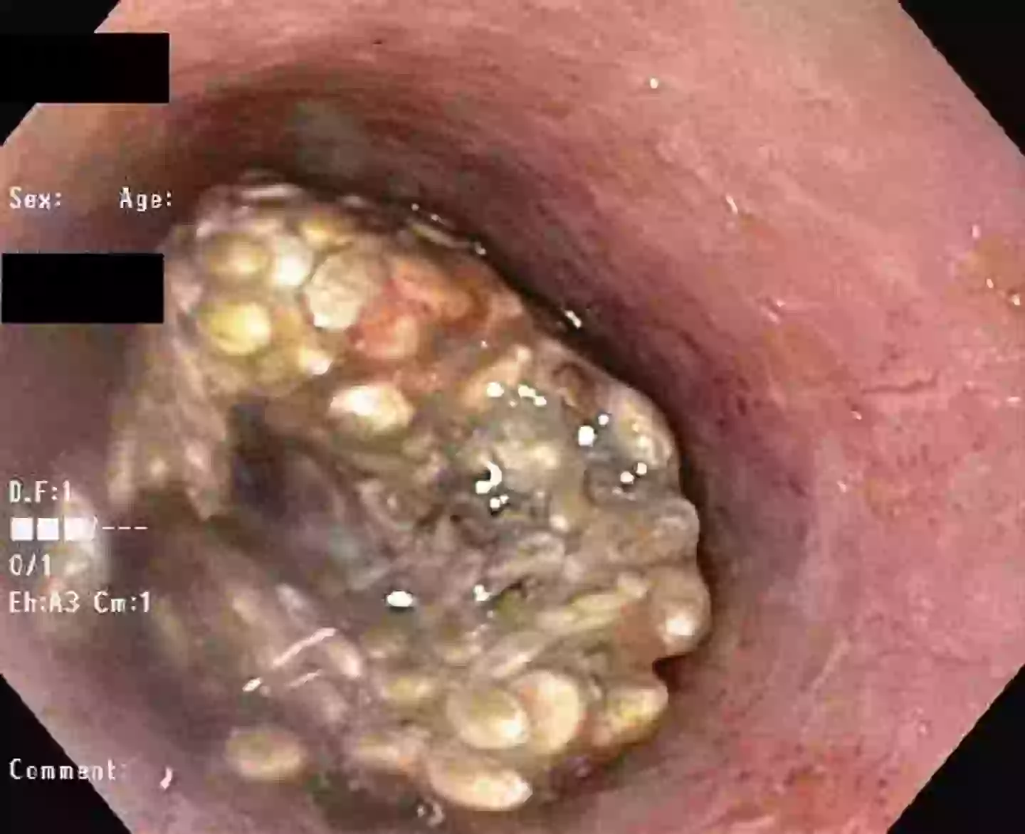 Not for one man, who was left with a block age after consuming the seeds dry (American College of Gastroenterology)