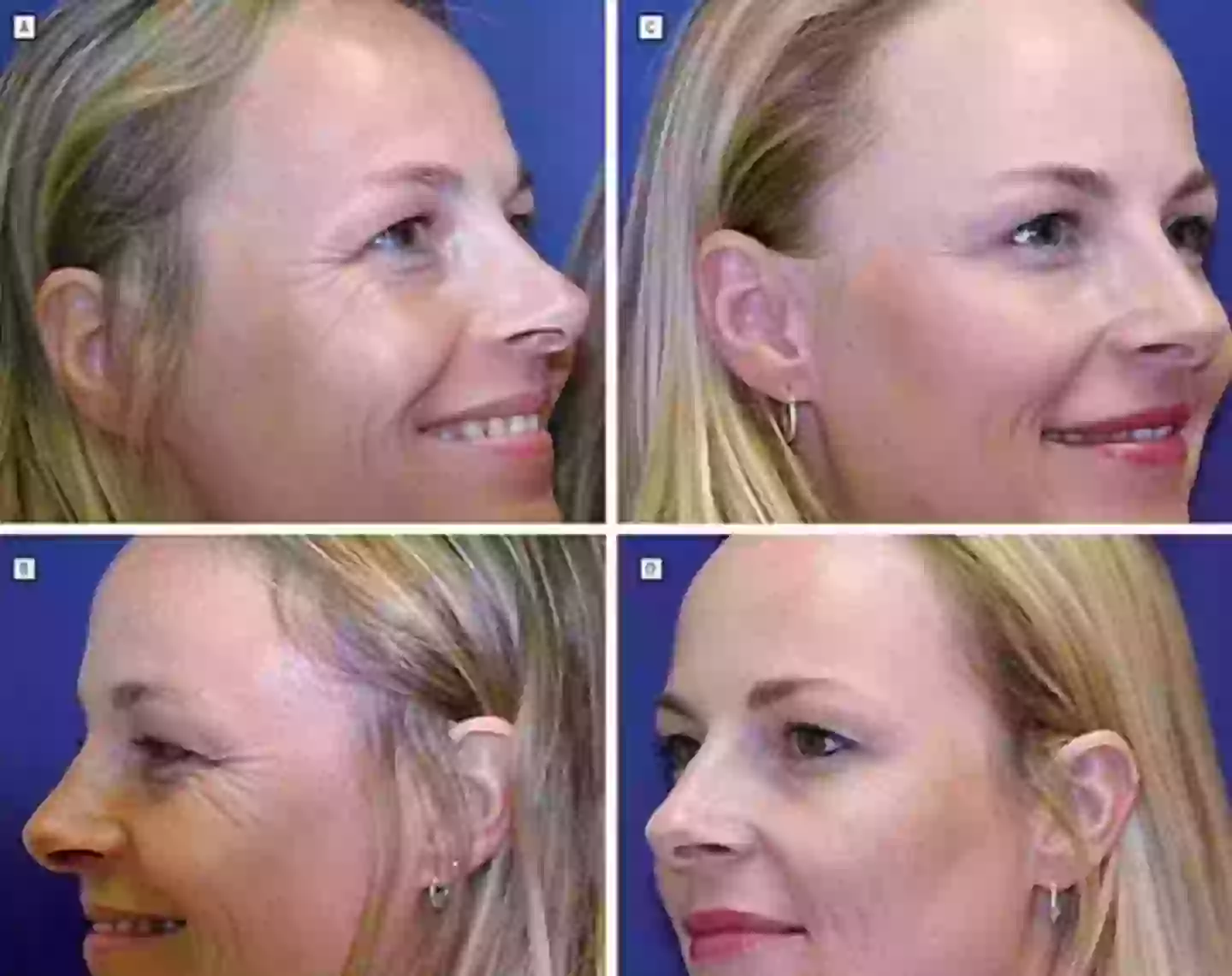 Images A and B show the results of the non-botox twin, while Images C and D reveal the differences with the Botox twin (American Medical Association)
