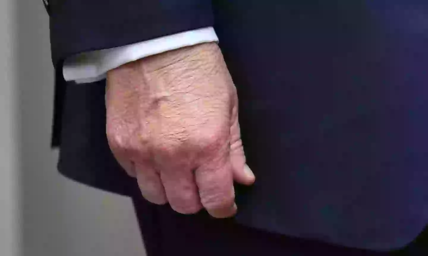 The large bruise on his right hand also remained visible on Monday (ROBERTO SCHMIDT/AFP via Getty Images)