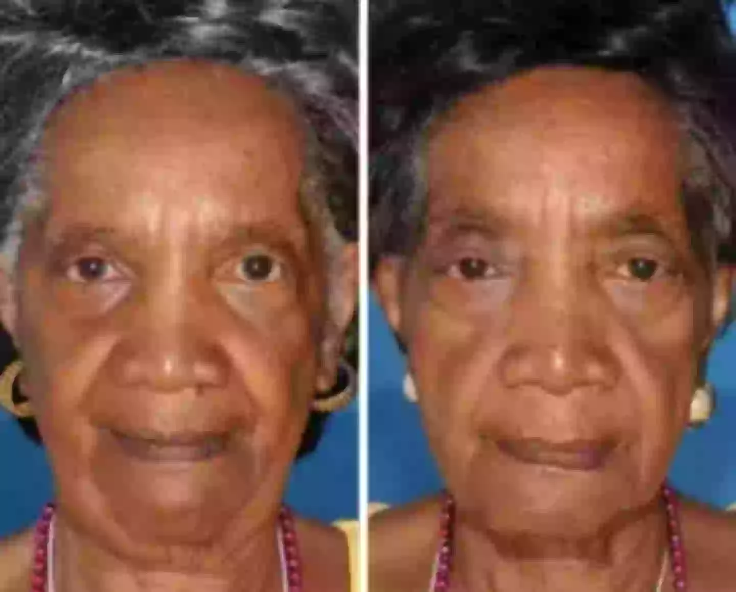 The twin on the left here is a non-smoker (American Society of Plastic Surgeons)