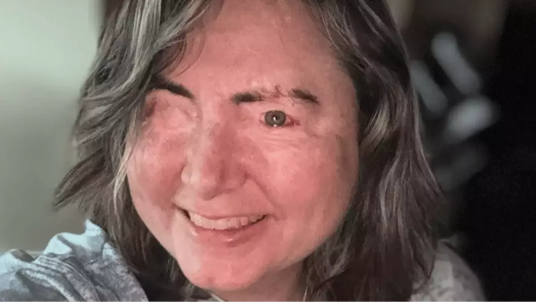 Jane Lo Rabies Woman who was hours from death became the first person ever to survive ...