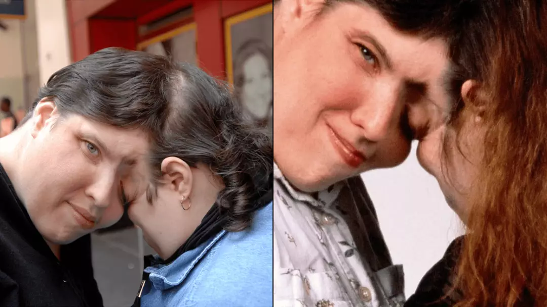 3 Conjoined World's oldest conjoined twins who lived to 62 explained reason why ...