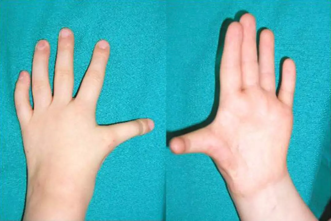 Dimelia Rare ‘mirror hand’ syndrome causes one hand to be completely symmetrical