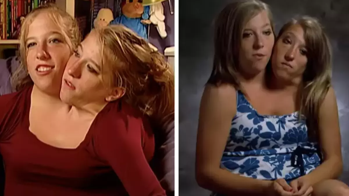 Reason why parents of conjoined twins Abby and Brittany Hensel decided not to separate them - Life - Tyla