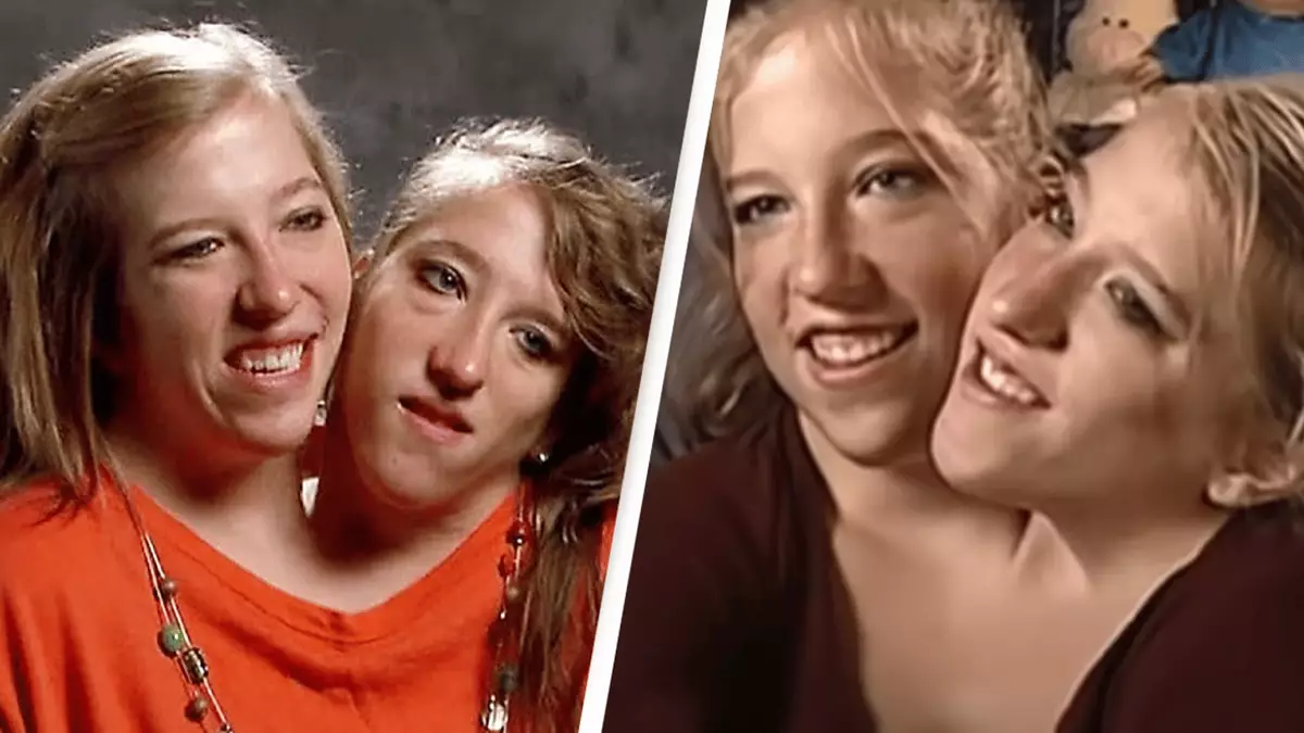Conjoined Sentiments Mom of conjoined twins answers question everyone is wondering after ...