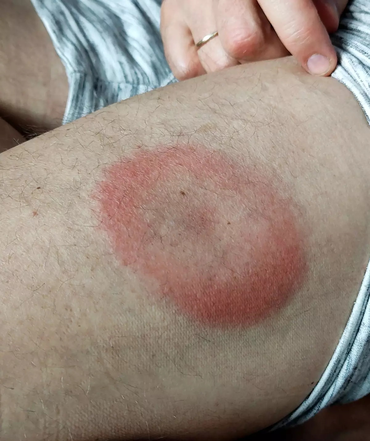 Doctor Issues Warning Over Hidden Symptoms Of Lyme Disease As Tick doctor-issues-warning-over-hidden-symptoms-of-lyme-disease-as-tick