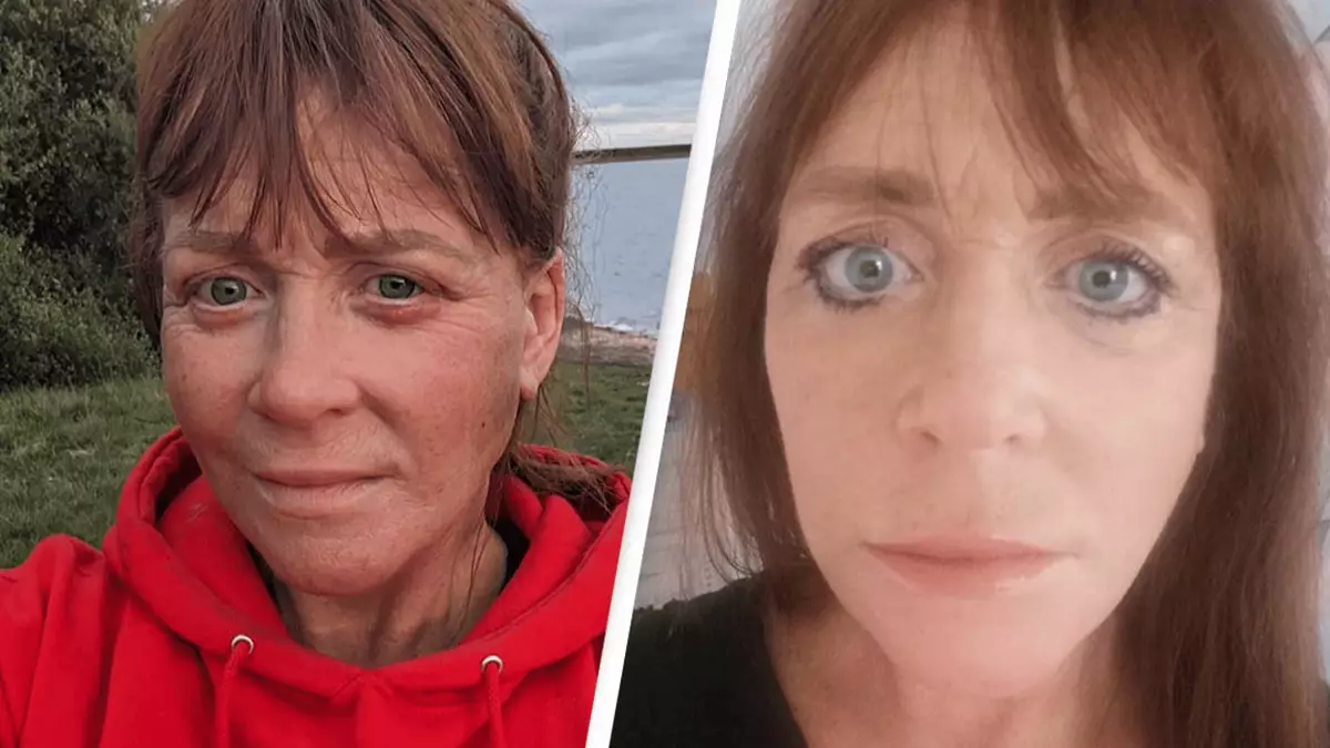Woman reveals 'horror' surgery to fix her face after weight loss left ...