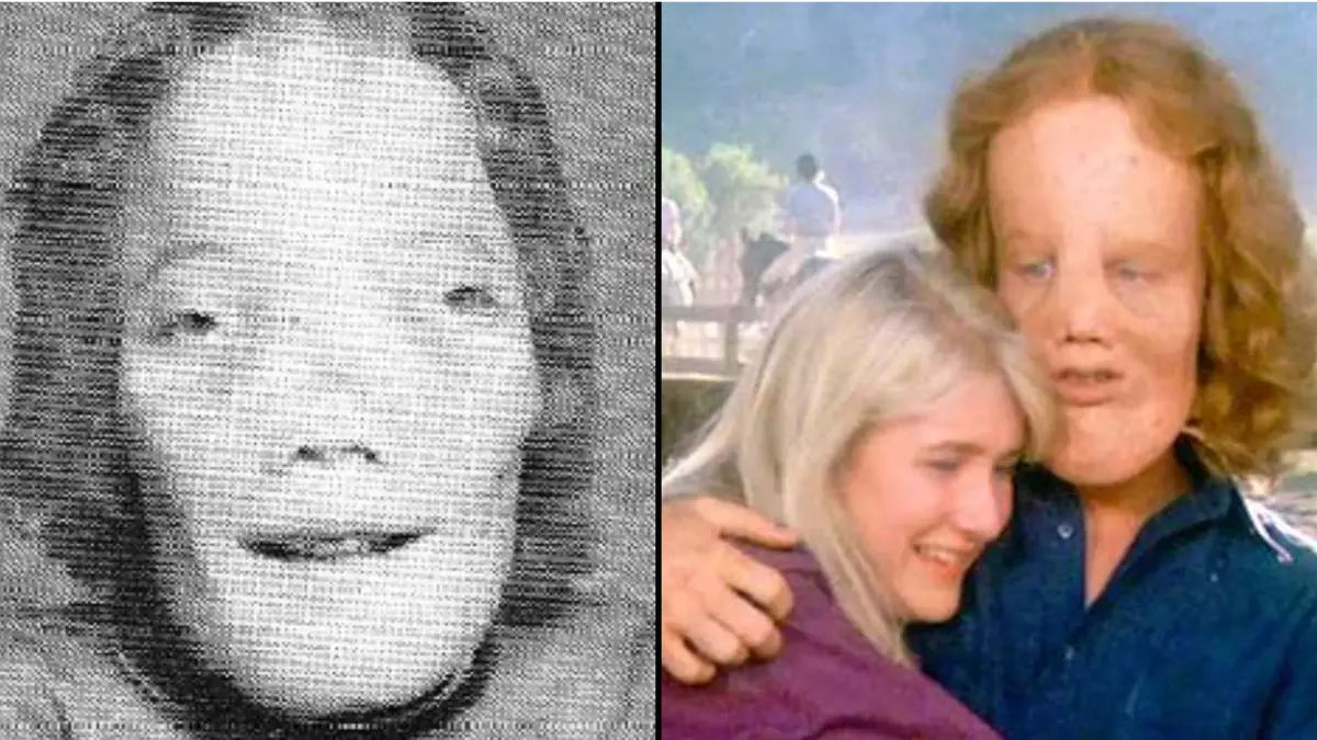 Tragic real life story of boy whose rare deformity inspired the famous film 'Mask'