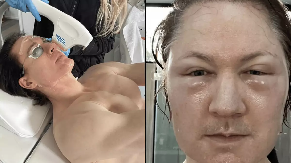 Biohacker who spends m a year to get teen body shares what happened when he injected fat into face – Technology Biohacker who spends m a year to get teen body shares what happened when he injected fat into face – Technology