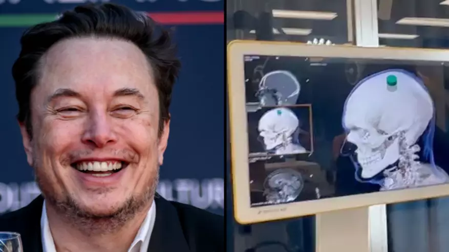Elon Musk reveals first Neuralink brain chip has been implanted in a ...