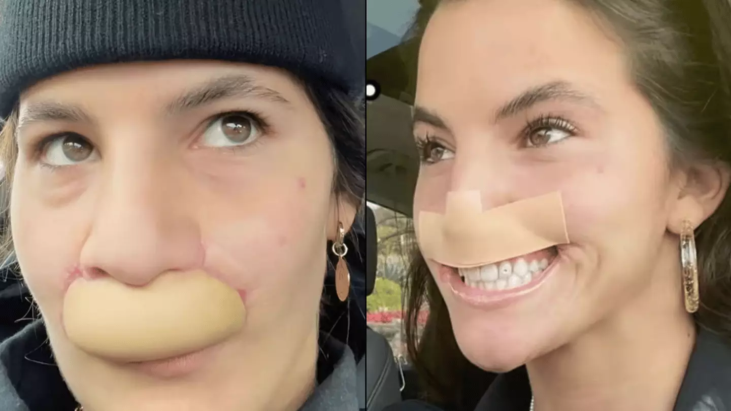 Cheek Bit Off Model whose lip was bitten off by dog shows off transformation after ...