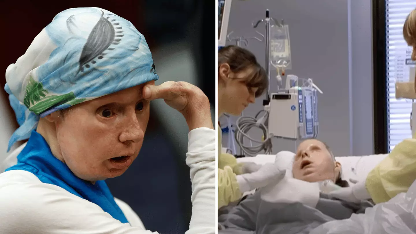 Face Rip Off Woman whose face was ‘ripped off’ by chimpanzee shares unbelievable ...