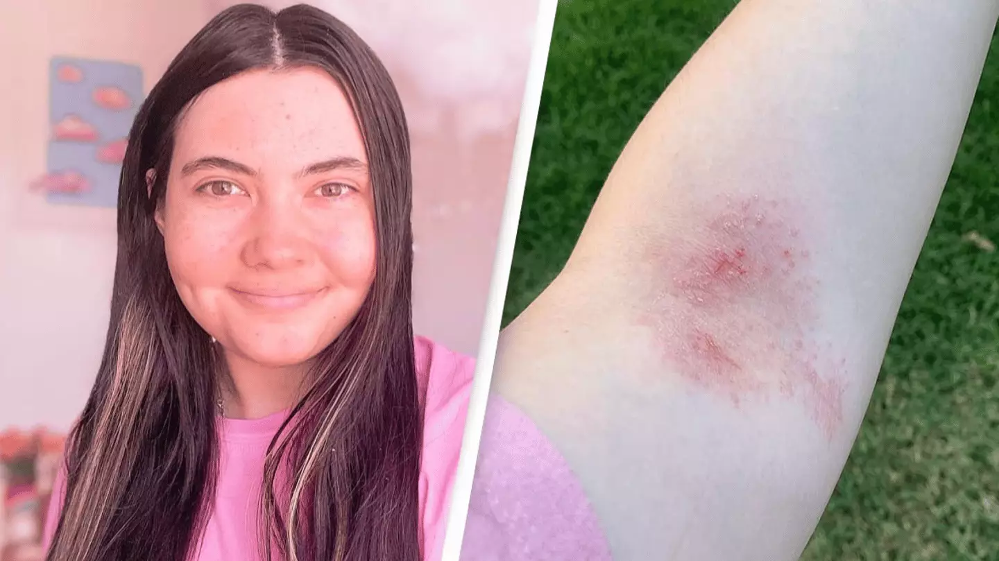 Unfiltered Water Rash Woman allergic to water explains how she’s able to live with extremely ...