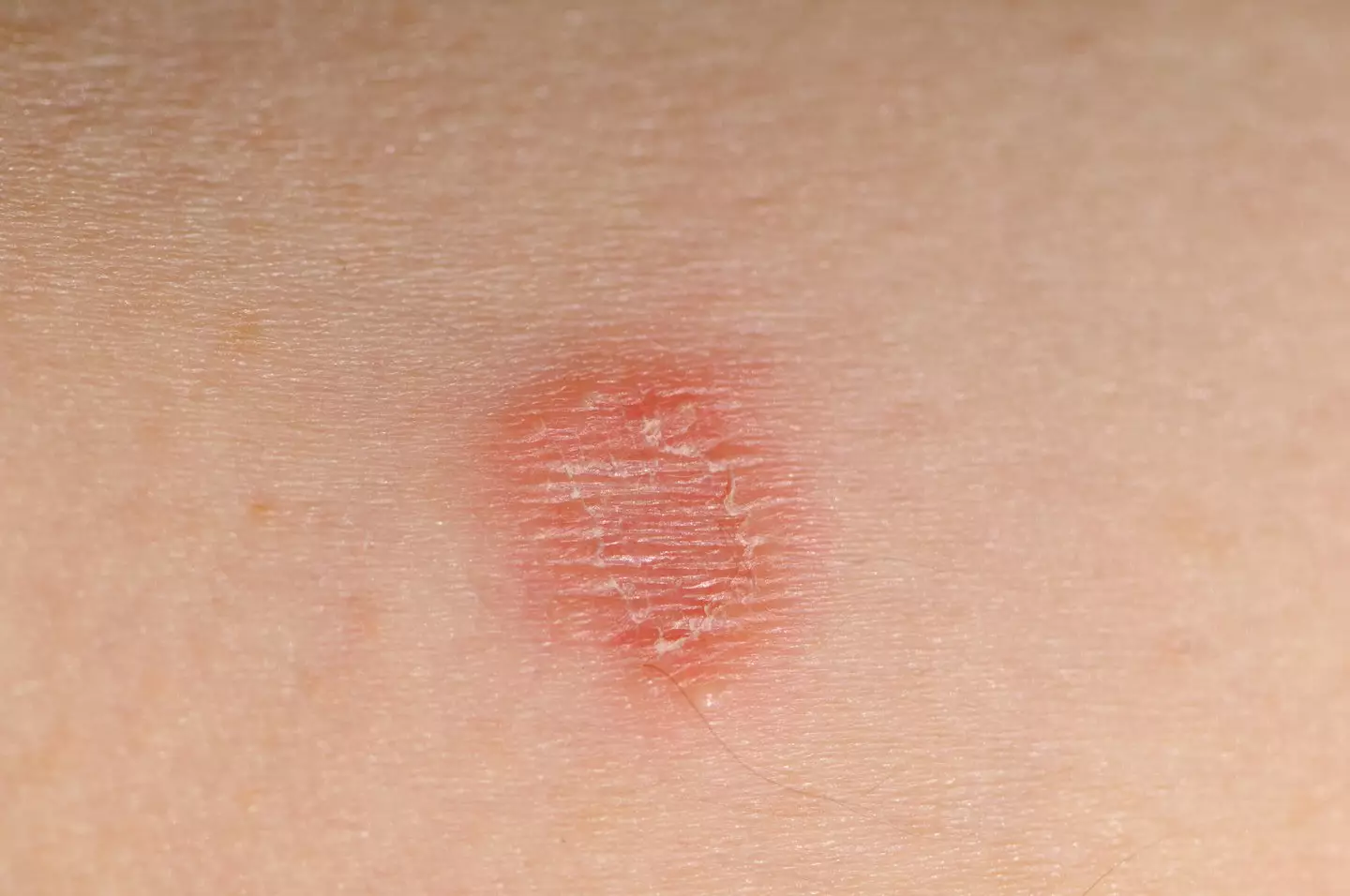 Barber S Rashes Urgent health warning issued to Brits who get skin fades at barbers