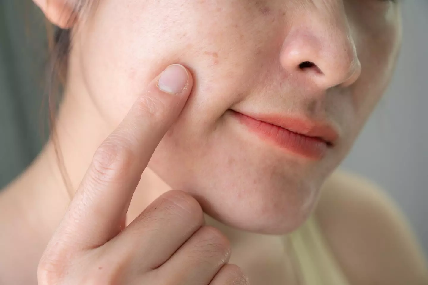 Triangle Method Pimples Dermatologist explains why you should never attempt to pop a spot in ...