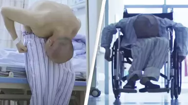 'Folded man' finally gets surgery to stand up straight after 28 years of suffering from rare disease