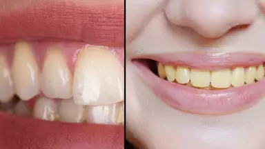 Dentist says there is one common mistake that leads to people’s teeth turning yellow