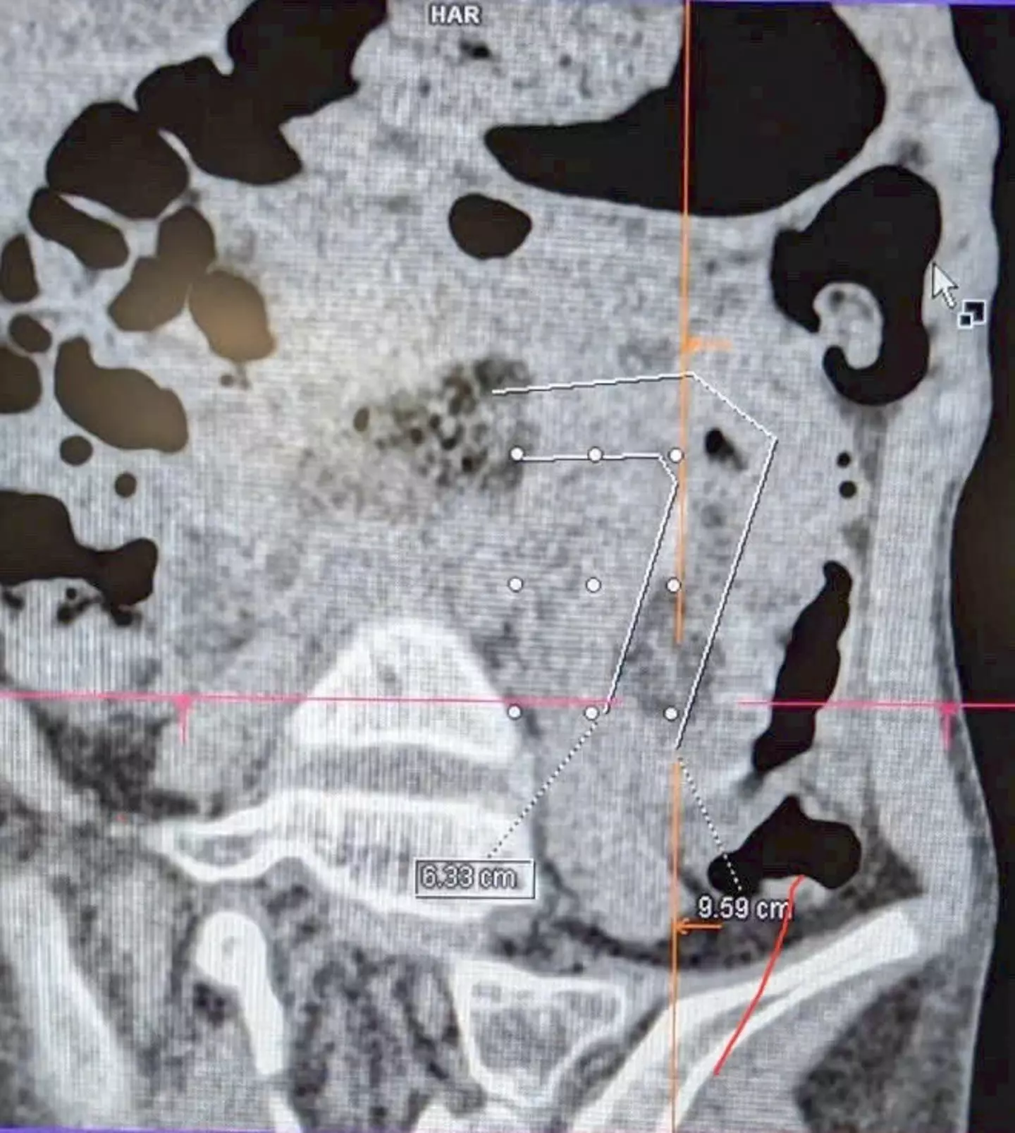 A nine-year-old girl who ate her own hair was admitted to hospital (Franco-Vietnamese Hospital)