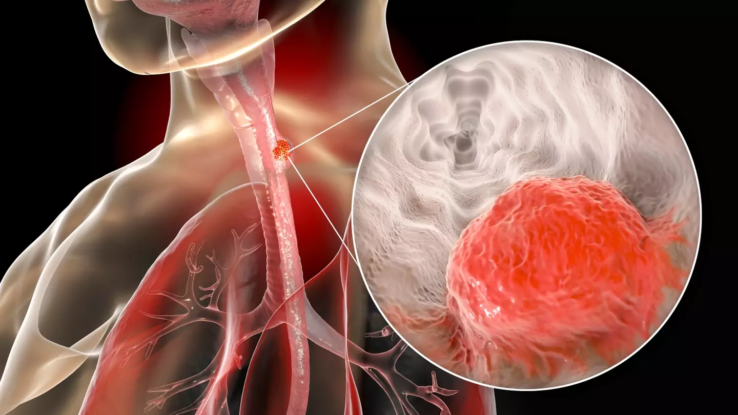 Around 20% of oesophageal cancer sufferers will survive it for five years or more (KATERYNA KON/SCIENCE PHOTO LIBRARY/Getty Images)