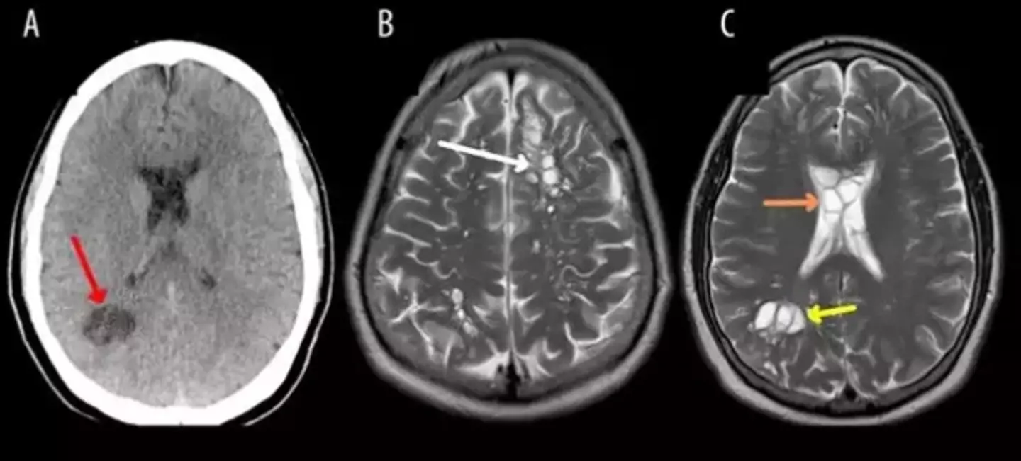 Scans of the patient's brain showing the cysts - American Journal of Case Reports