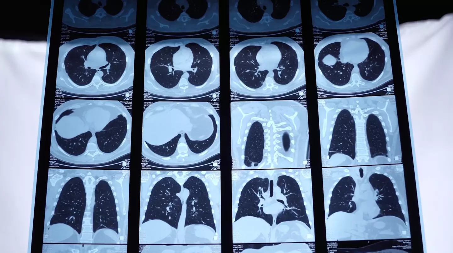 Experts urge a UK ban on quartz to prevent further silicosis cases (YouTube/Asbestos and Dust Diseases Research Institute)