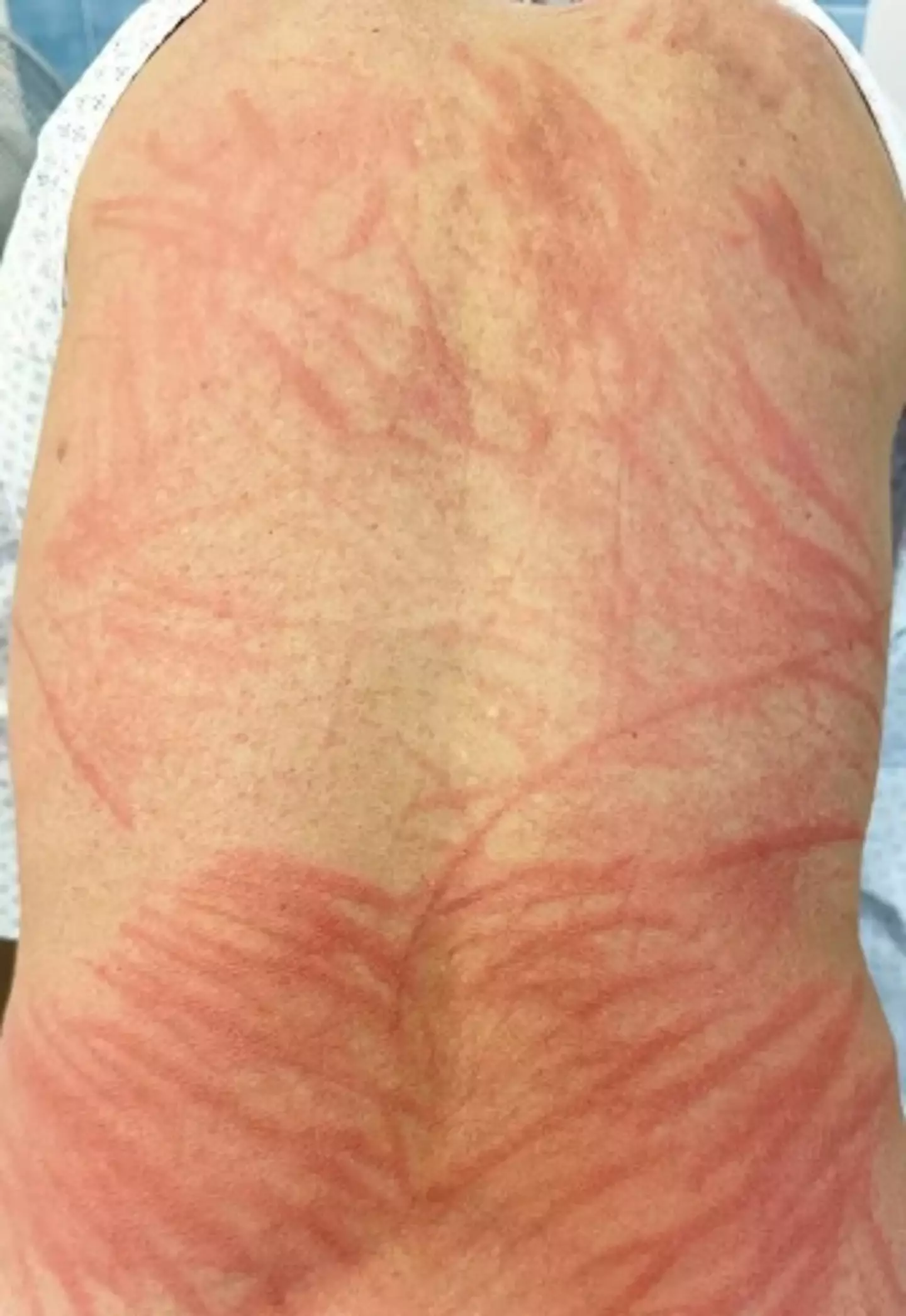 The rash is no joke (The New England Journal of Medicine/ Eglė Janušonytė/ Jöri Pünchera)