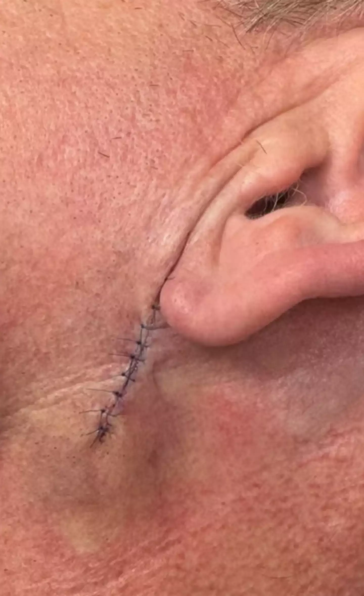 Ramsay underwent surgery to remove basal cell carcinoma (Instagram/Gordon Ramsay)