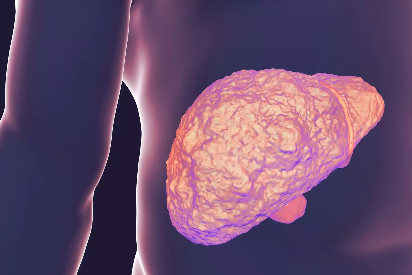 Liver cirrhosis can have fatal consequences - KATERYNA KON/SCIENCE PHOTO LIBRARY via Getty Images