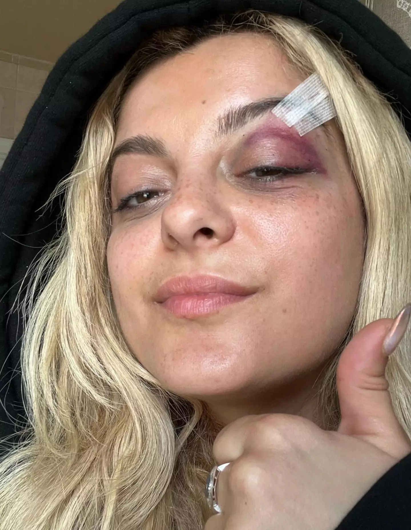 Bebe Rexha updated fans with a picture of her injuries.