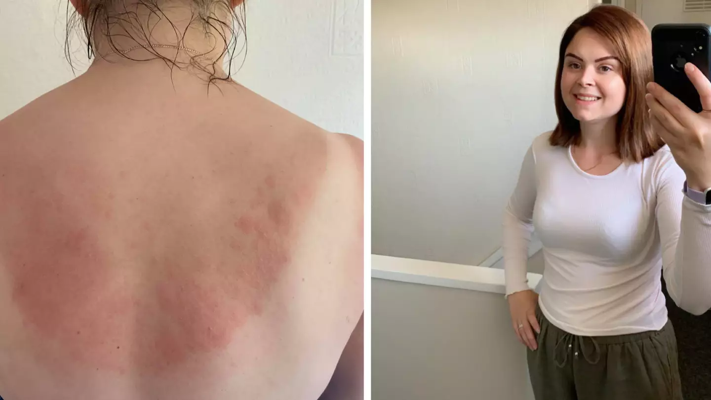 Woman Scared To Leave The House After Developing Sun Allergy That Causes Blisters