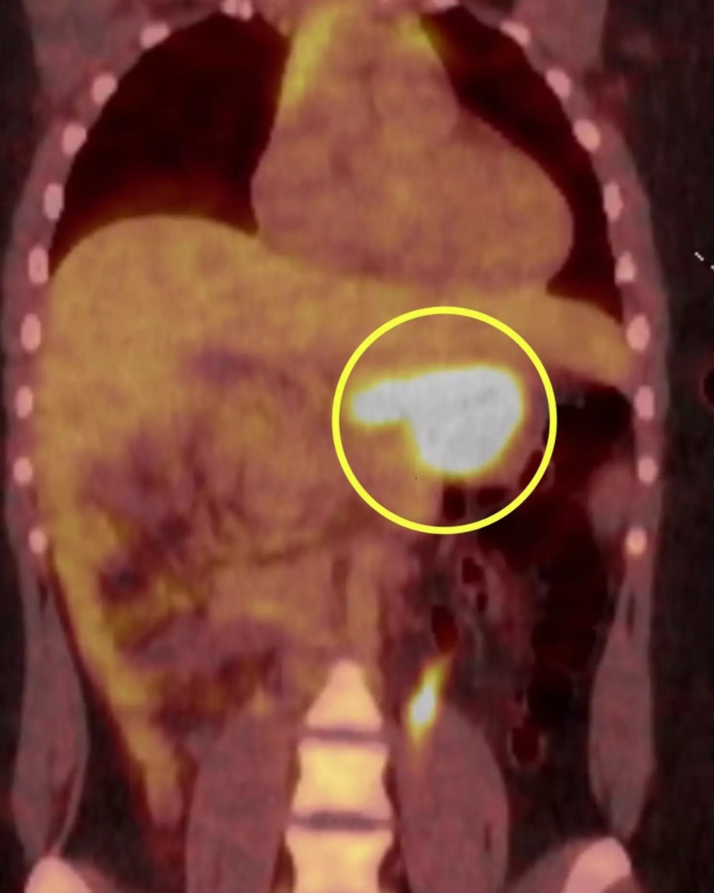 A tumour was found in her stomach (Kennedy News & Media)