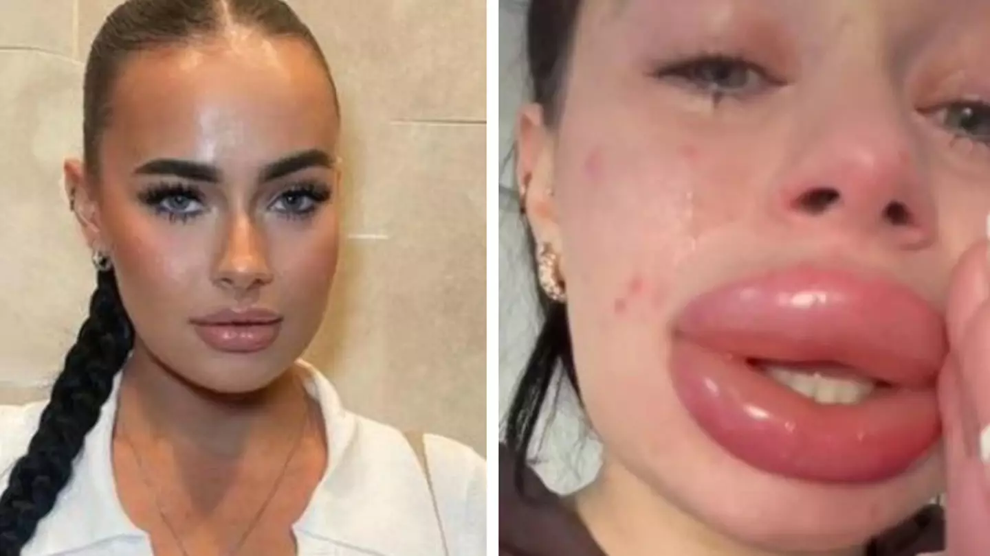 Horrified woman issues warning after free lip filler goes horribly wrong
