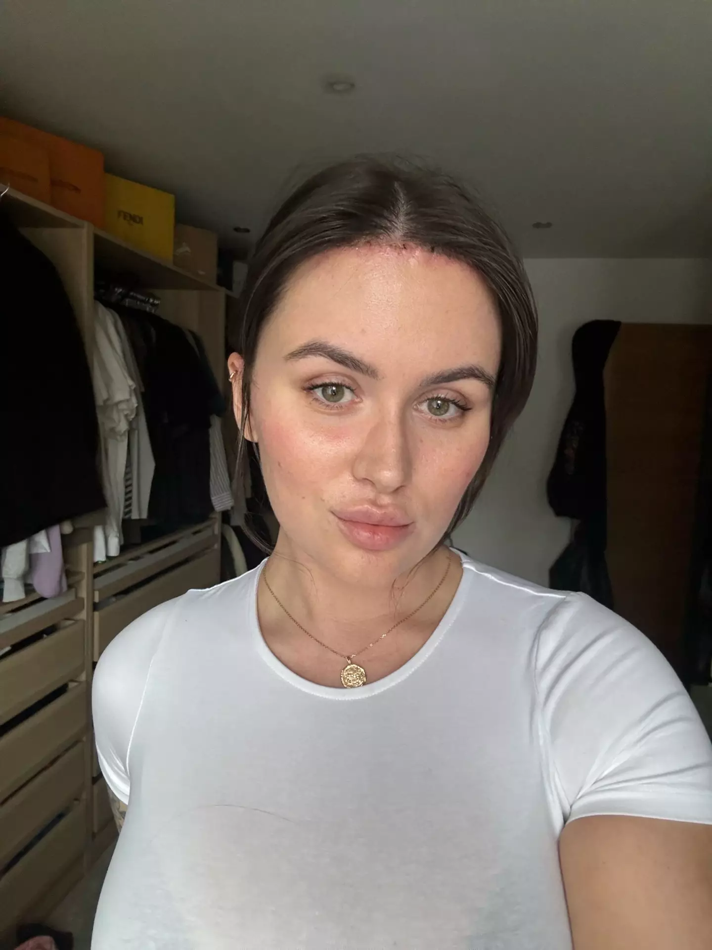 Beth revealed this is first time she's gone out with her forehead on show for 20 years.