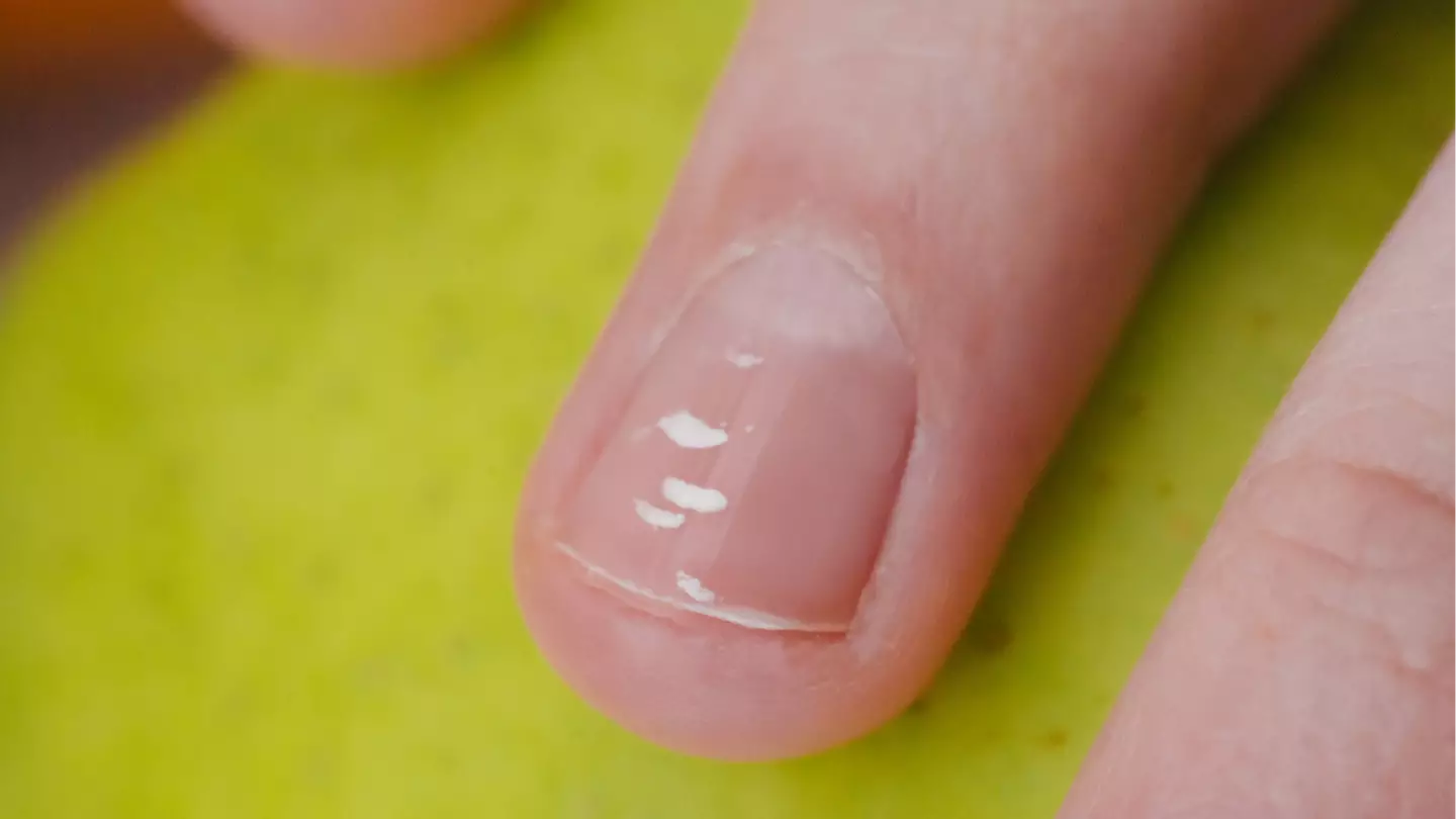 Real reason you might spot 'white dots' on your nails