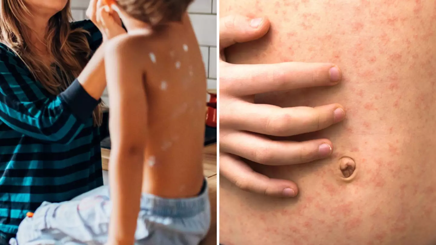 Mum issues serious measles warning over baby's 'awful' symptoms