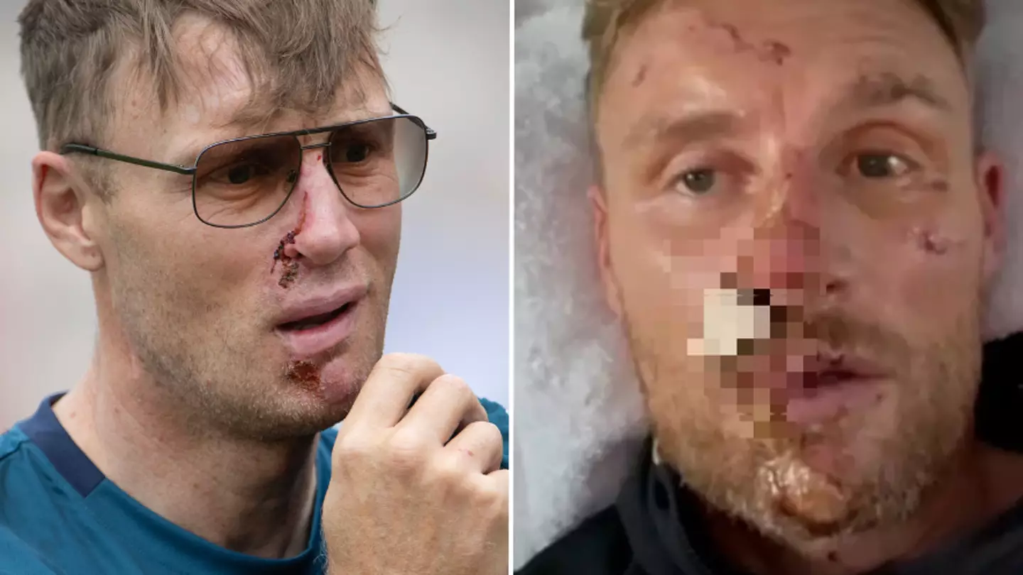 Freddie Flintoff makes heartbreaking admission as he reveals full extent of facial injuries from near-fatal crash