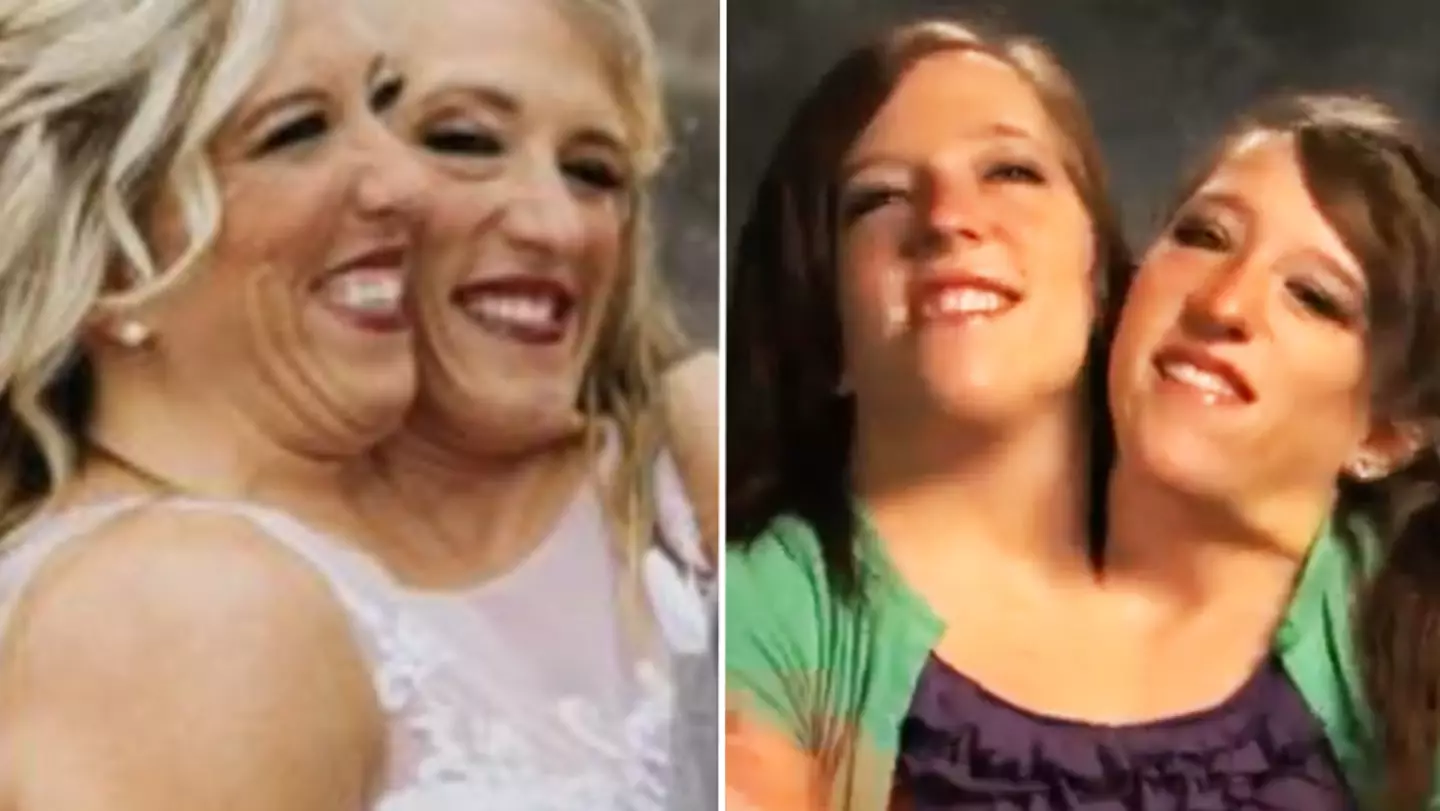 Conjoined twin Abby Hensel is now married