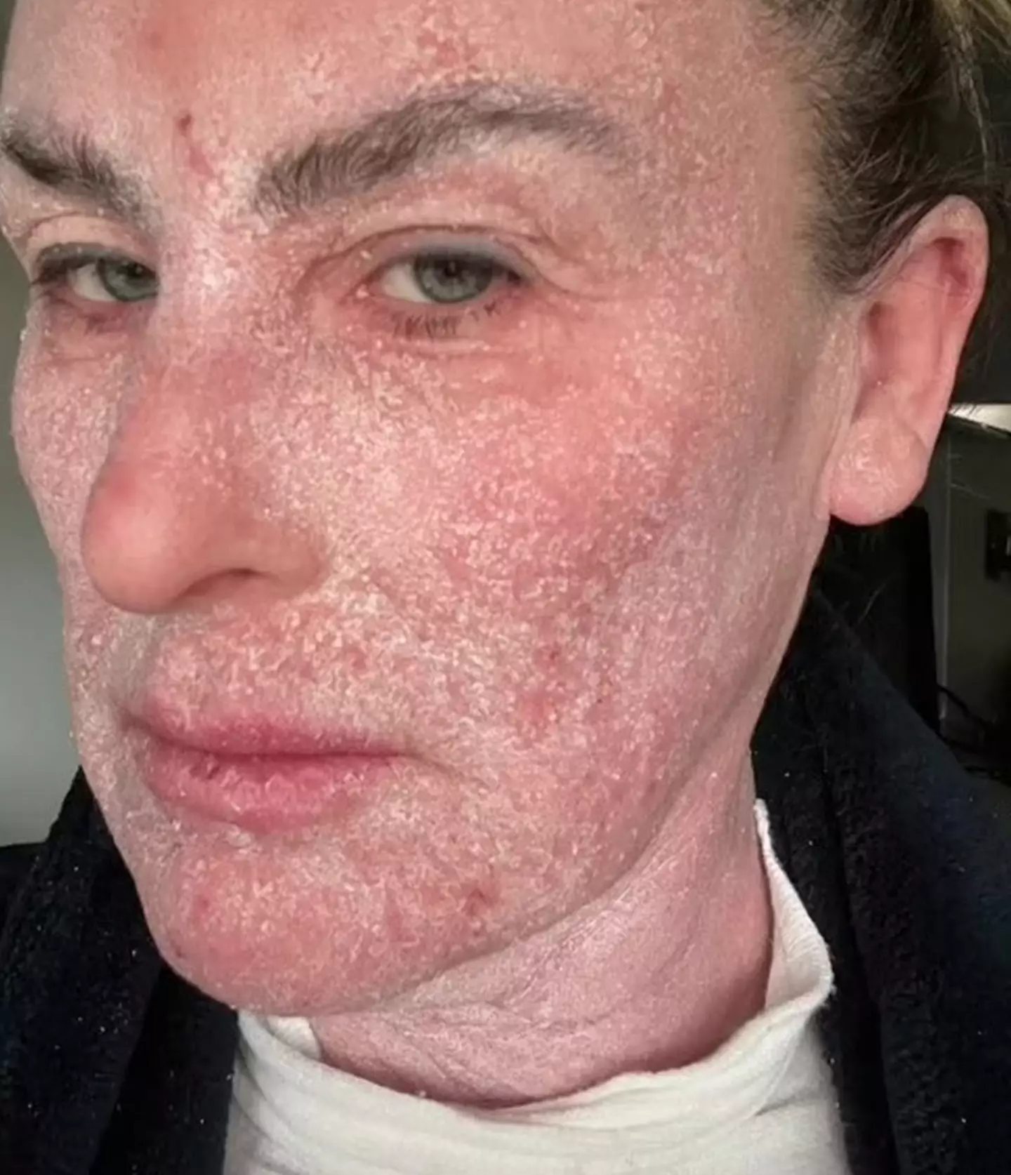 Karyn Flett has suffered with severe eczema for the majority of her life.