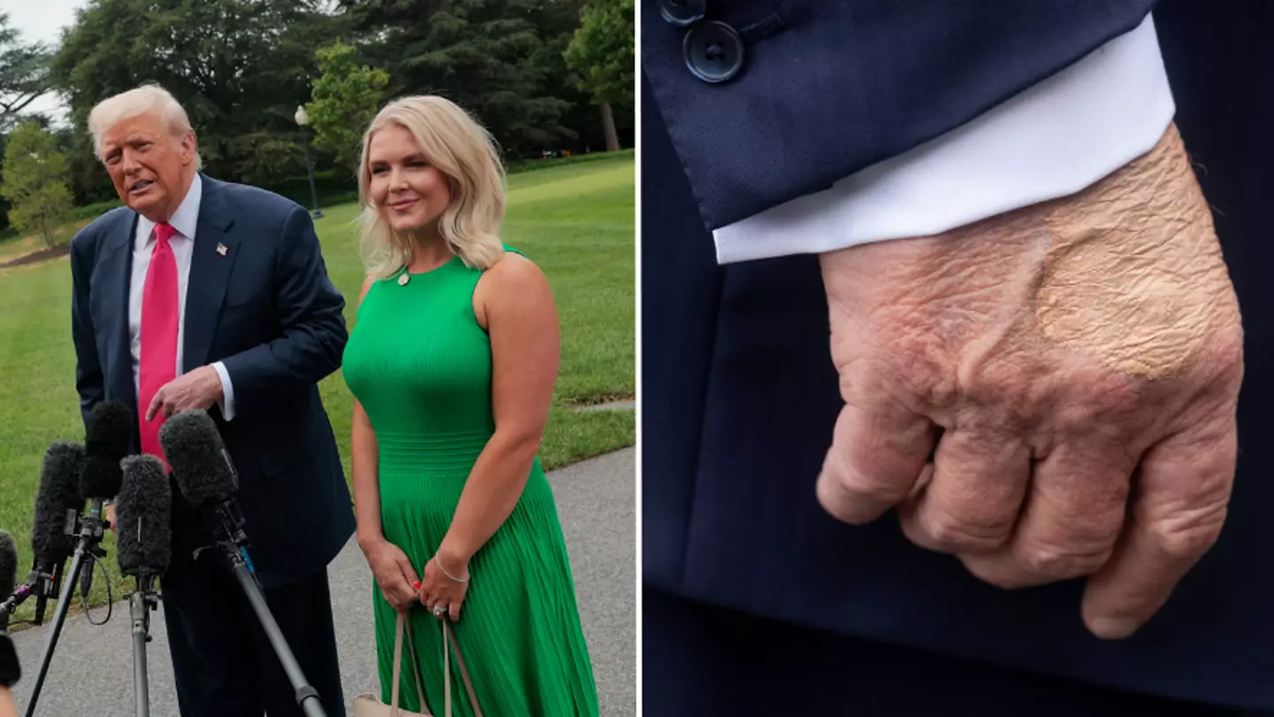 Donald Trump’s ‘mysterious’ bruise explained by officials after people spot it has 'reappeared'