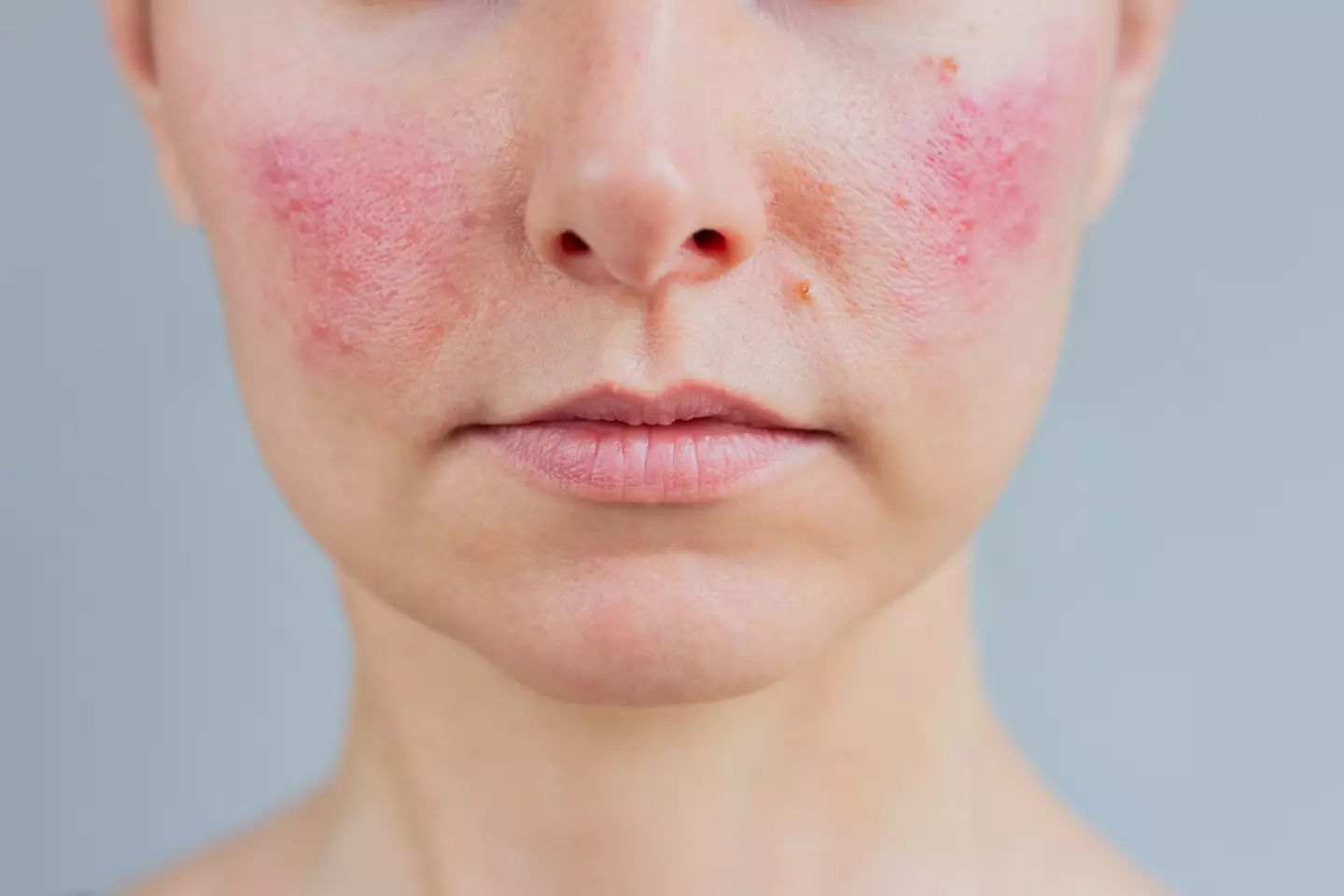 The condition is especially prevalent over the winter months (Getty Stock Image)