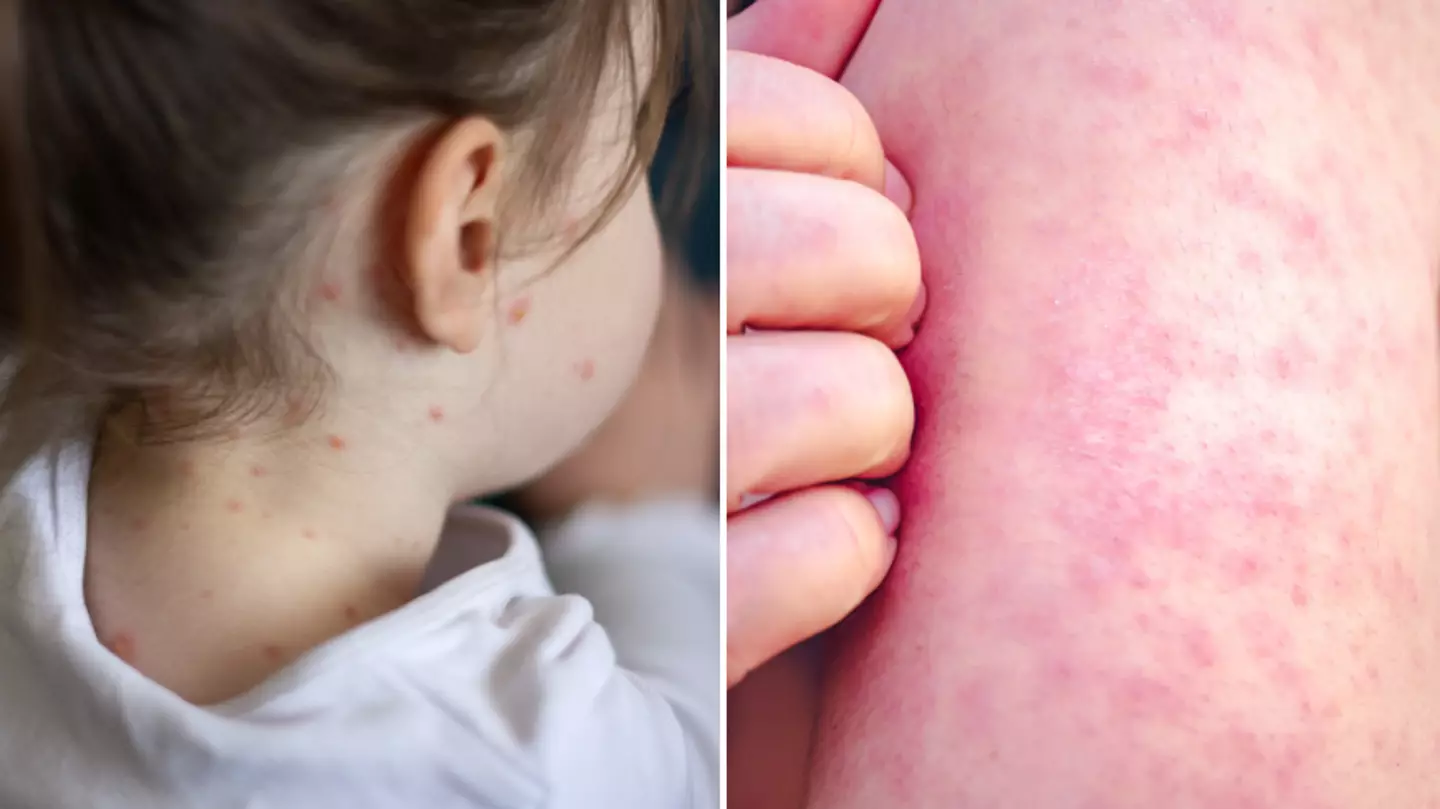 Full list of measles symptoms to look out for as Brits face 'alarming rise' in cases