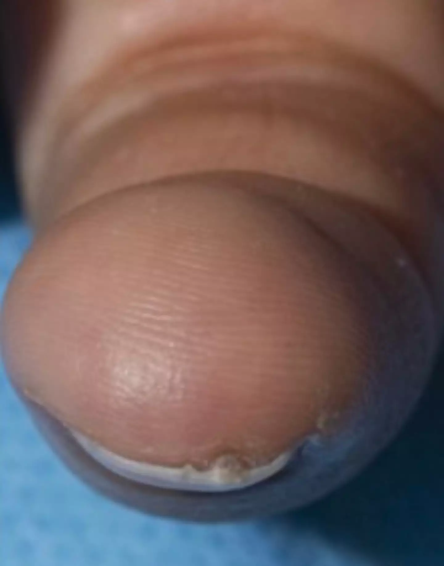 Researchers are now urging that nail screening will be particularly valuable for a patient with a family history of melanoma. (Dermatology Consultation Service)