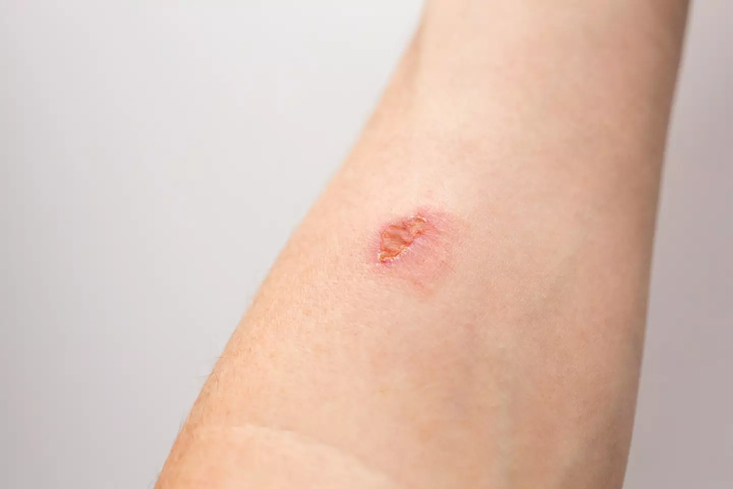Finally, skin cancer such as melanoma can manifest as an abnormality in the skin (Getty stock image)