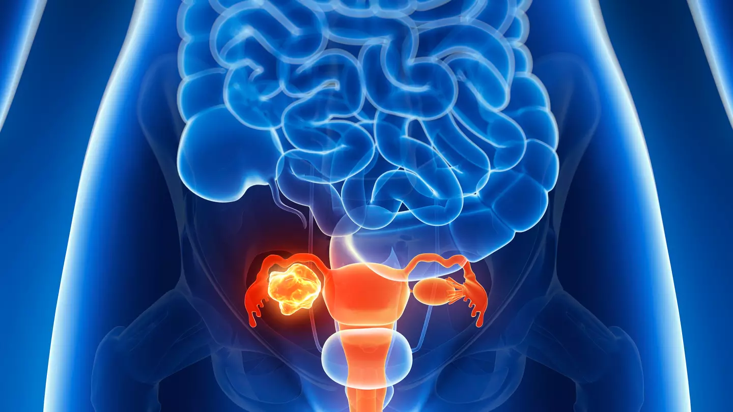 Six silent symptoms of ovarian cancer that most people ignore