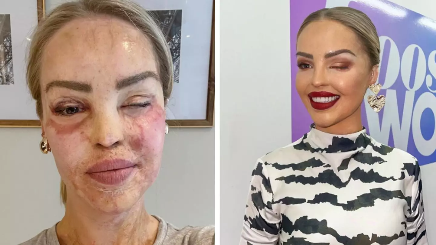 Katie Piper says she is making 'the best of life' after her eye is sewn shut for a year