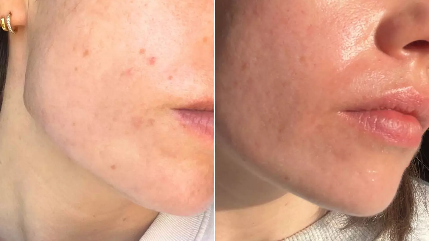 Before and after treatment (Photo: LADbible Group)